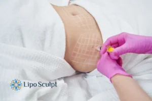 Are The Results From Aqualyx Permanent? 1 Do you want to know how long Aqualyx Staffordshire results last?