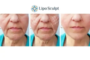 Explaining Morpheus8 And What It Can Do For You 3 Boost your confidence with Morpheus8 Staffordshire call our team today!