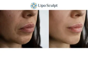 Explaining Morpheus8 And What It Can Do For You 4 Morpheus8 Staffordshire the best results - call our team today!