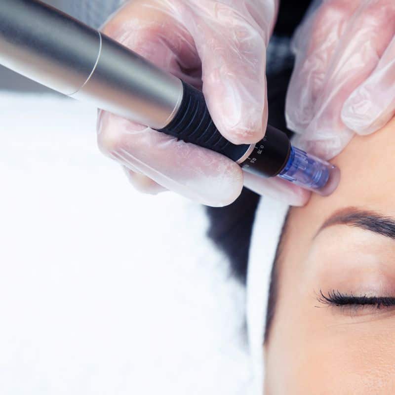 Morpheus8 treatment Staffordshire from Lipo Sculpt - Book in today!