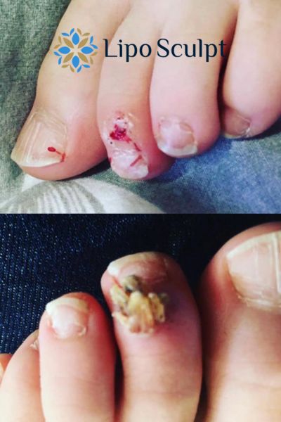 Wart removal customer results from Lipo Sculpt Staffordshire