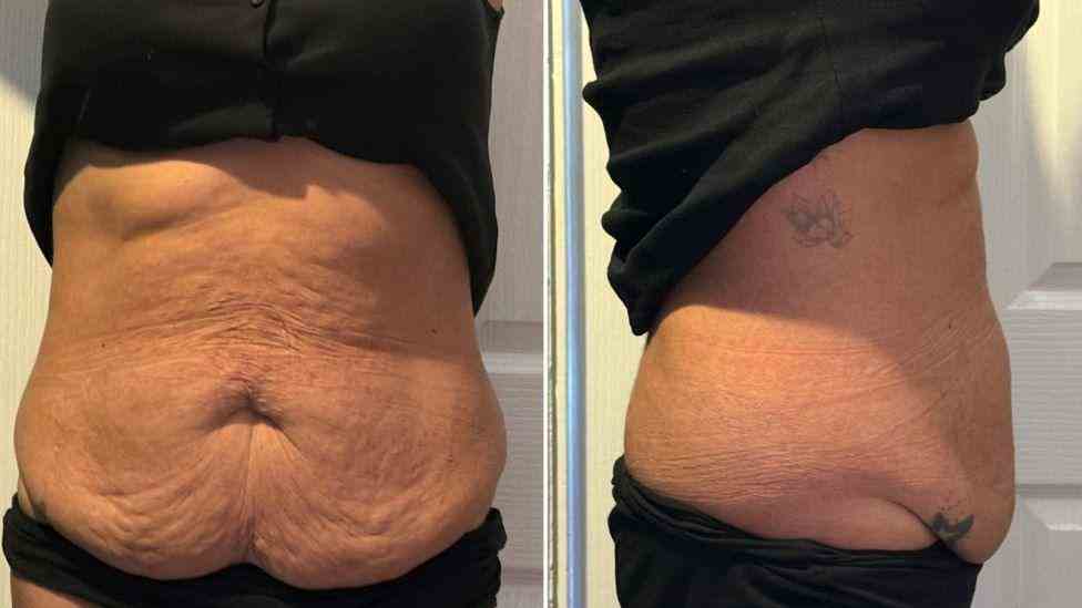 Lost the Weight but Not the Loose Skin? What You Should Know 1 Is It Definitely Loose Skin Staffordshire?